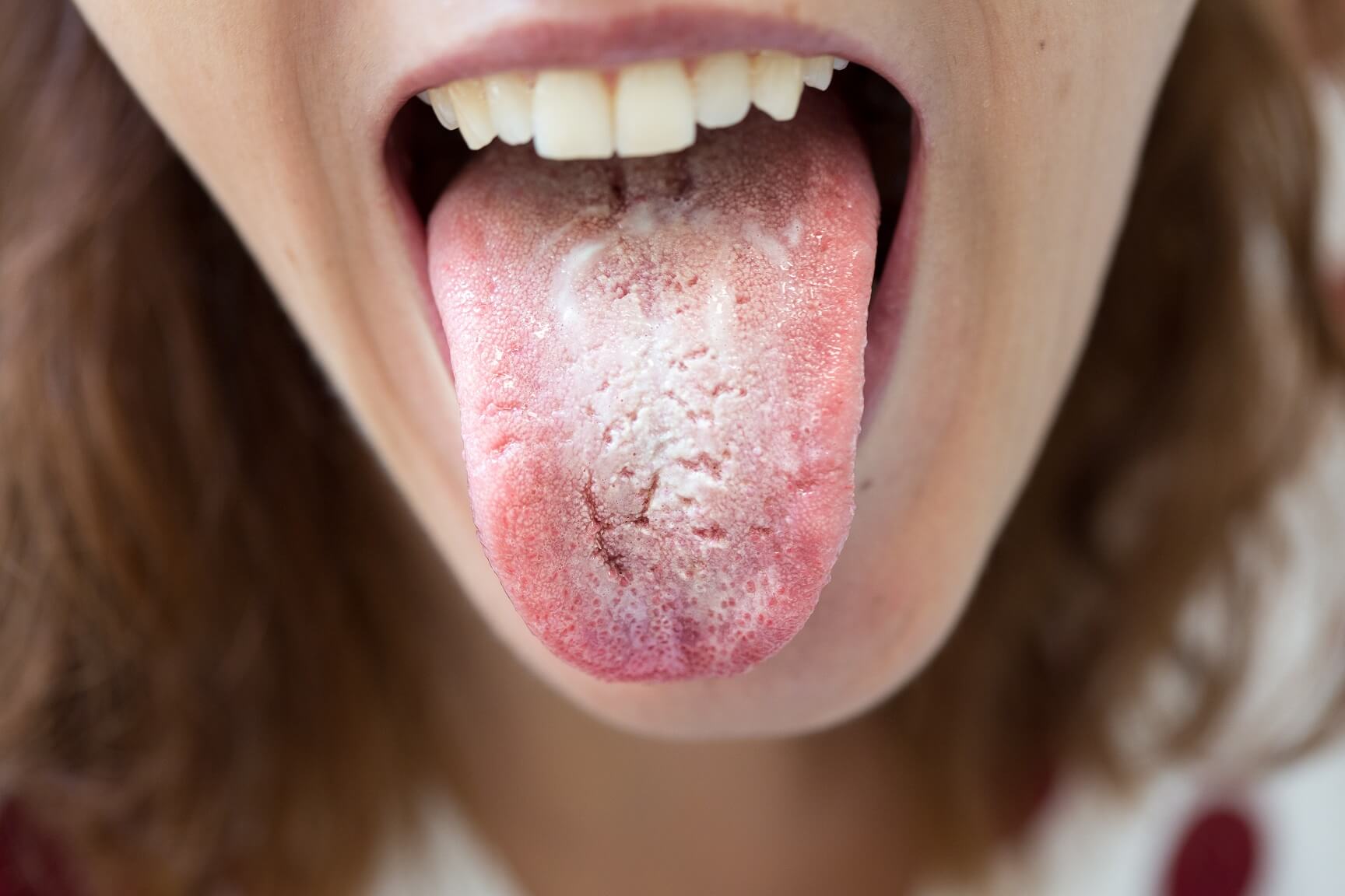Candida Albicans bioliek